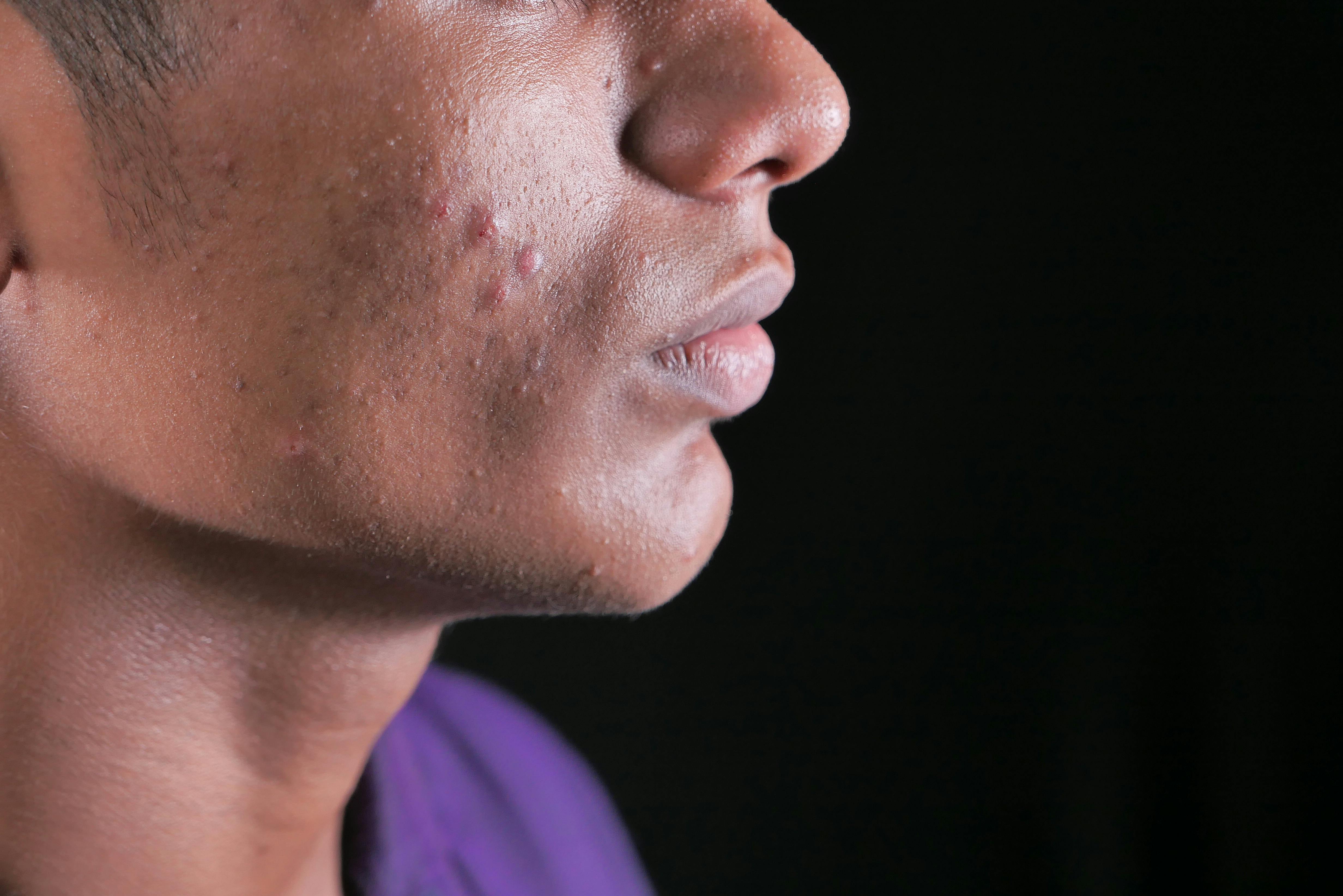 Man with pimples on face
